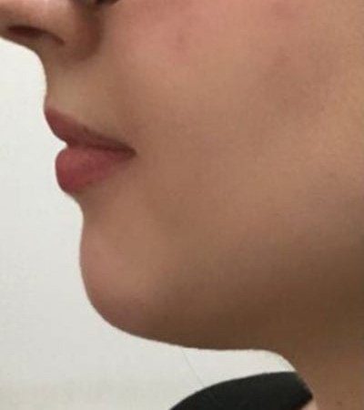 chin dermal filler