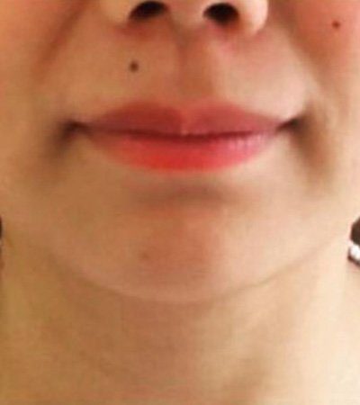 chin enhancement with dermal filler