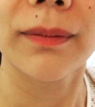 v shape chin dermal filler injection