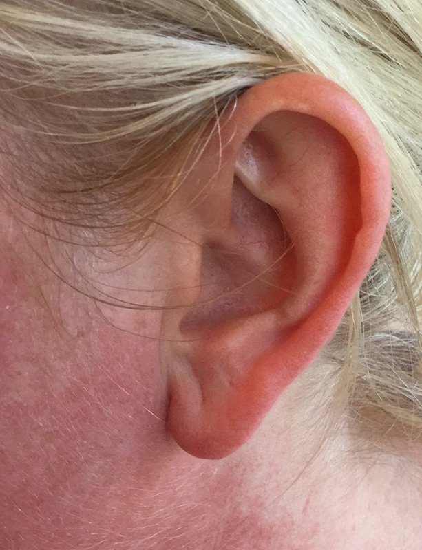 earlobe reduction surgery