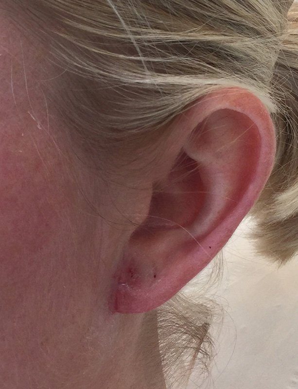 earlobe reduction treatment