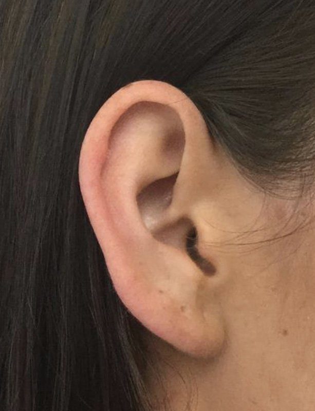 earlobe reduction surgery