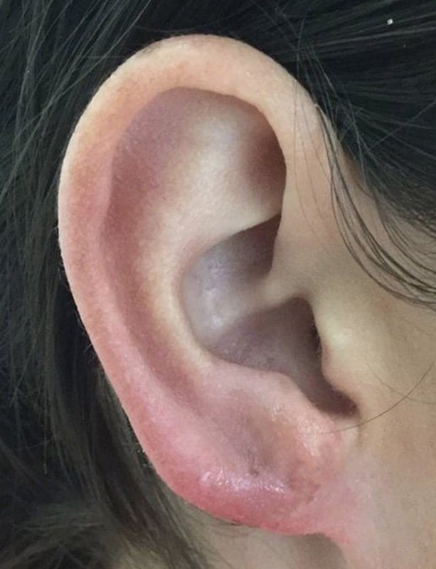 earlobe reduction