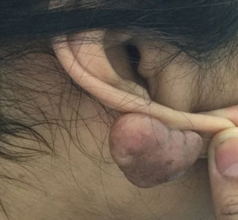 ear keloid removal
