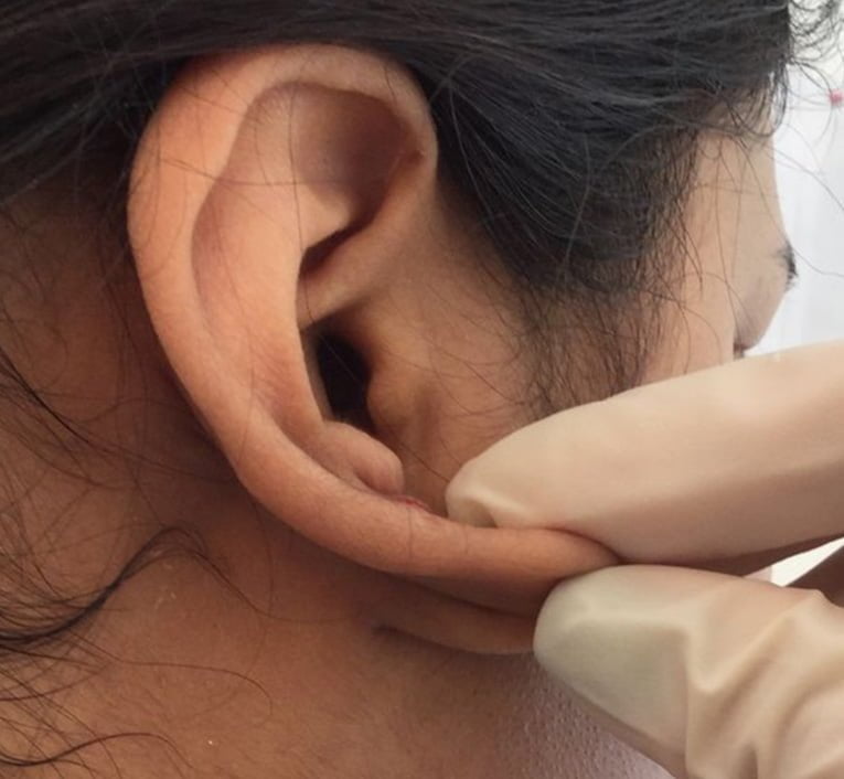 ear keloid removal treatment