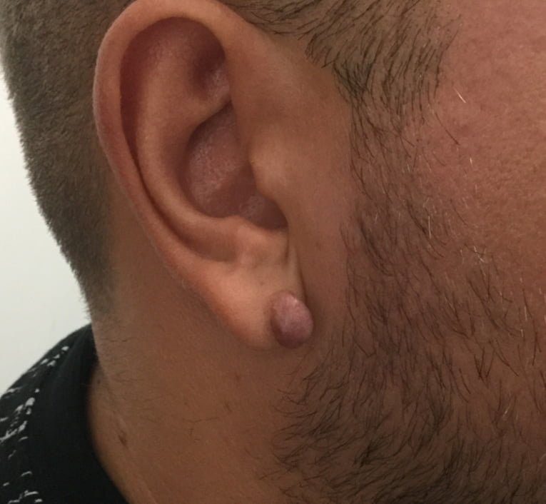 ear keloid scar removal