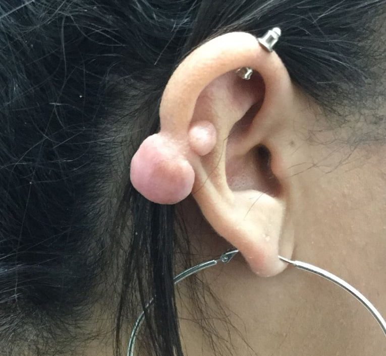 ear keloid removal