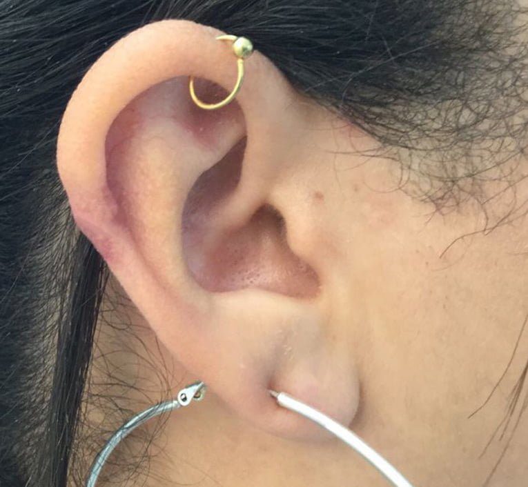 ear keloid removal