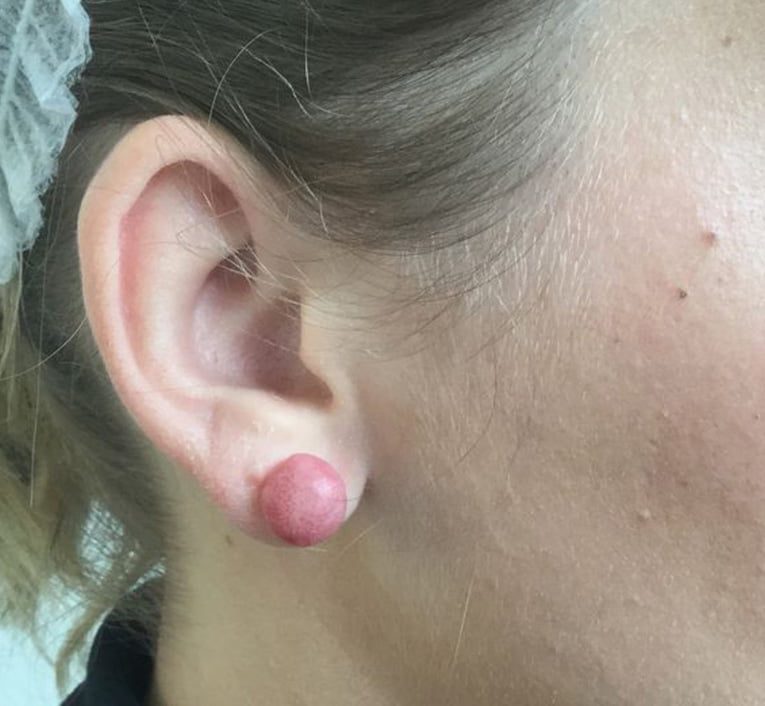 earlobe keloid removal