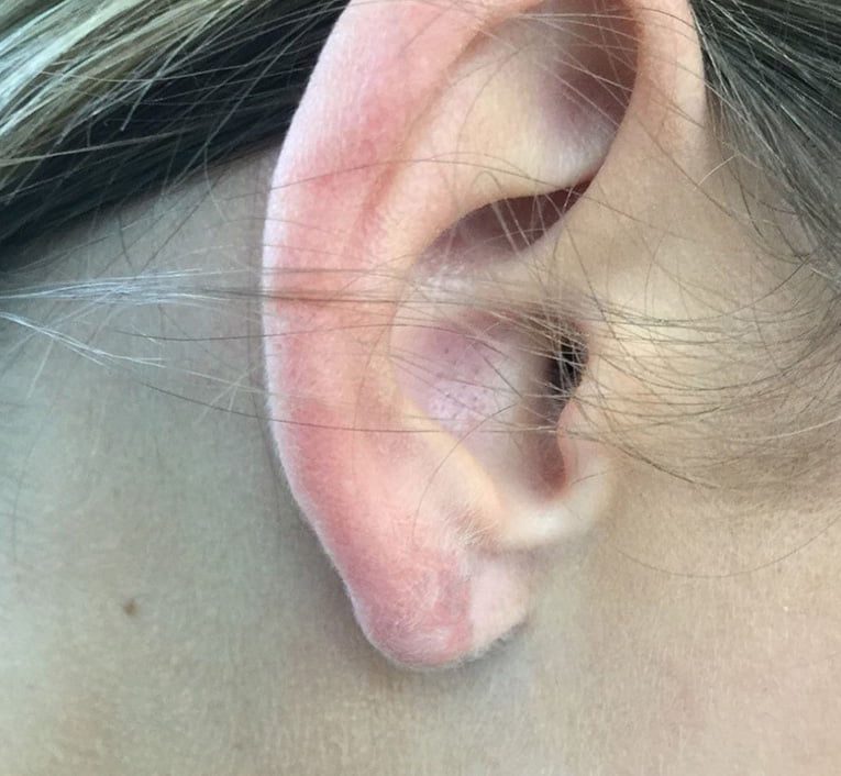 earlobe repair surgery