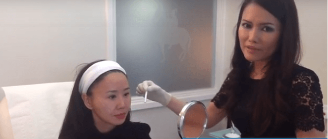 cheek dermal filler injection