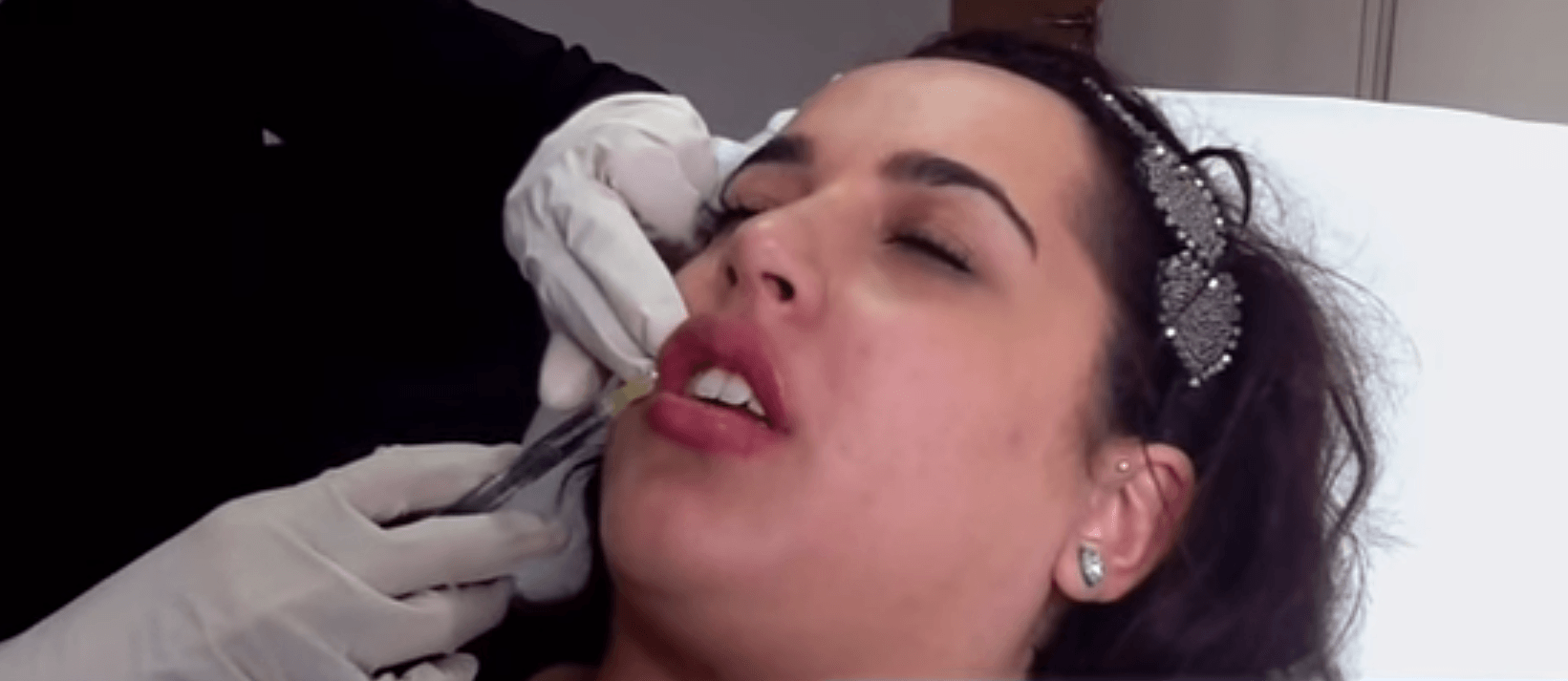 lip dermal filler injection
