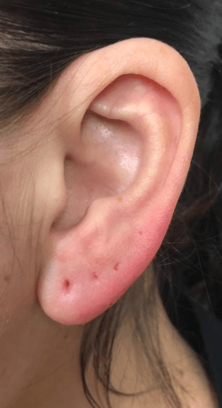earlobe repair treatment