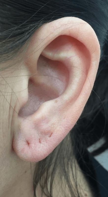 earlobe repair and reduction
