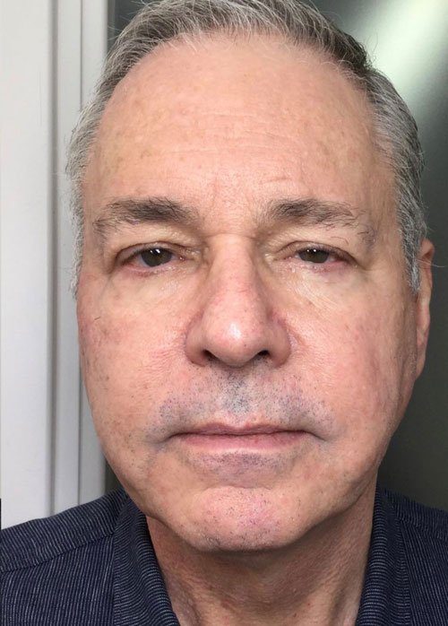 dermal filler treatment for man