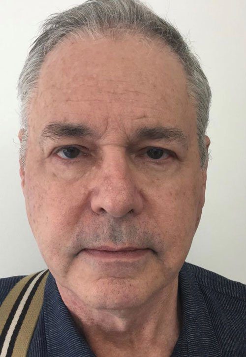 botox injection for man wrinkles