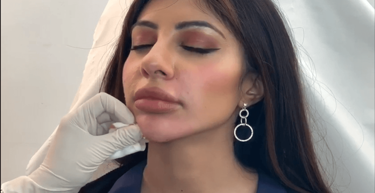 chin dermal filler injection