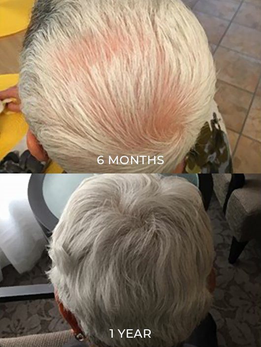 PRP hair loss treatment