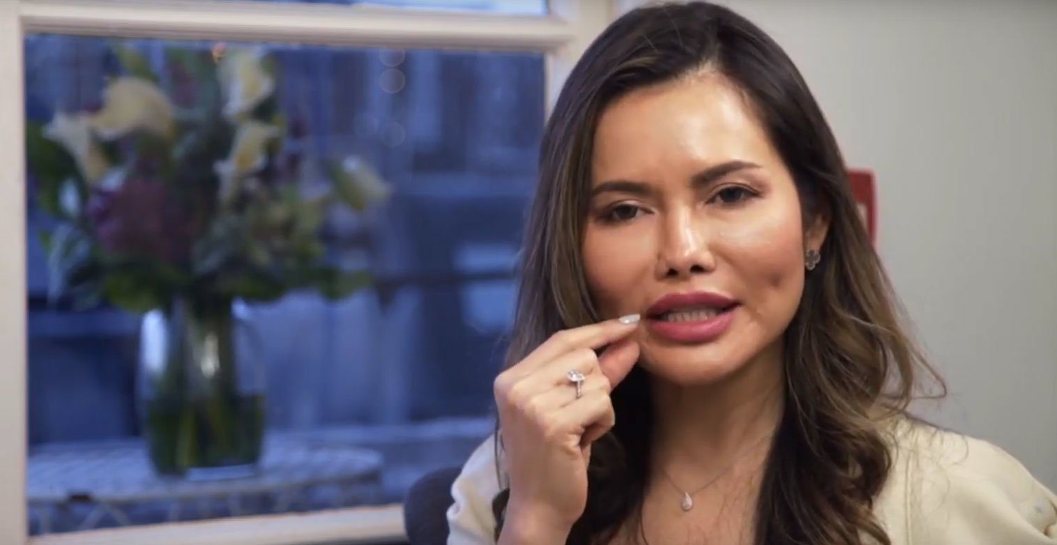 Gummy smile treatment with botox injection