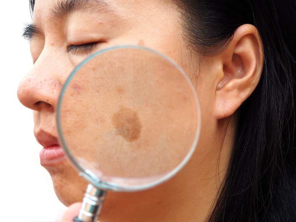 abnormal pigmentation intro