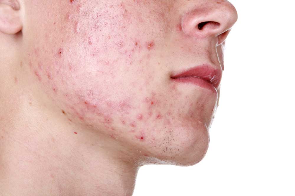 acne intro image