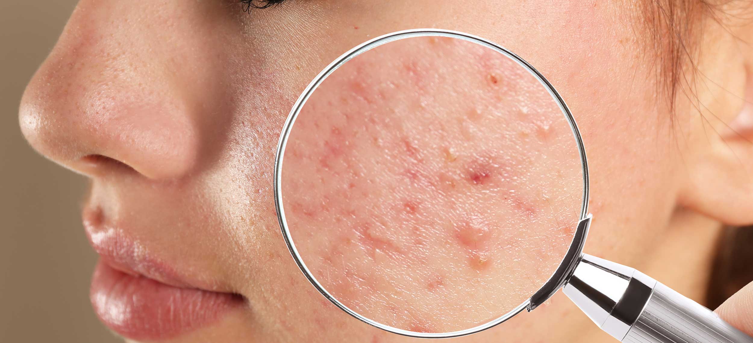 Inflammatory acne and redness