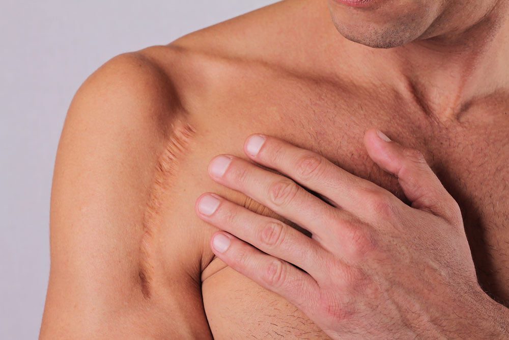scar atrophic intro image