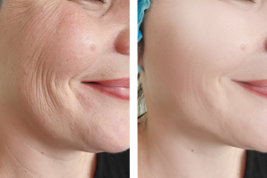 Non Surgical Facelift Results at The London Cosmetic Clinic