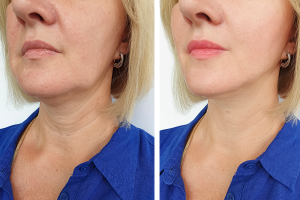 Best Non surgical facelift before and after