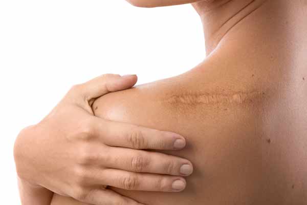 Remove Skin Scar London