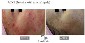 exosome treatment results