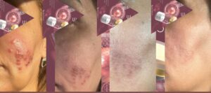 Exosome Treatment London Clinic