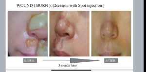 exosome results on skin at the london cosmetic clinic
