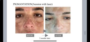 exosome for pigmentation before and after