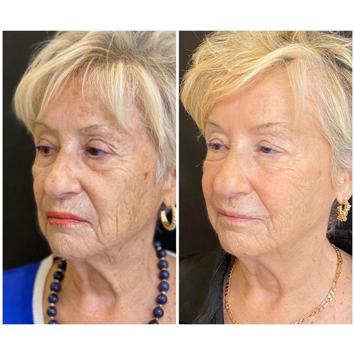 exosome before and after at The London Cosmetic Clinic