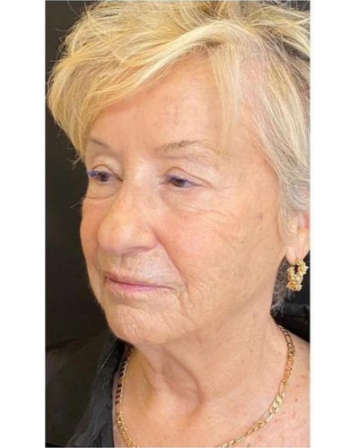 exosome treatment after in london