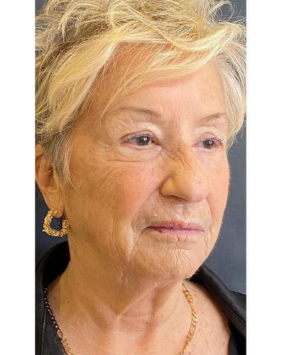 exosome treatment after at the london cosmetic clinic