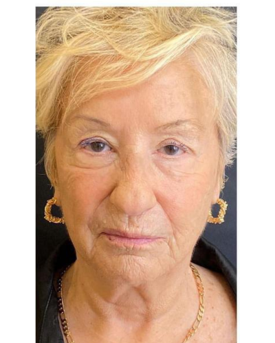 exosome treatment after