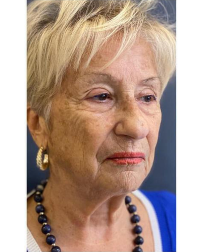 exosome treatment before at the london cosmetic clinic