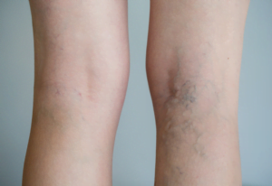 Varicose veins treatments in London before and after