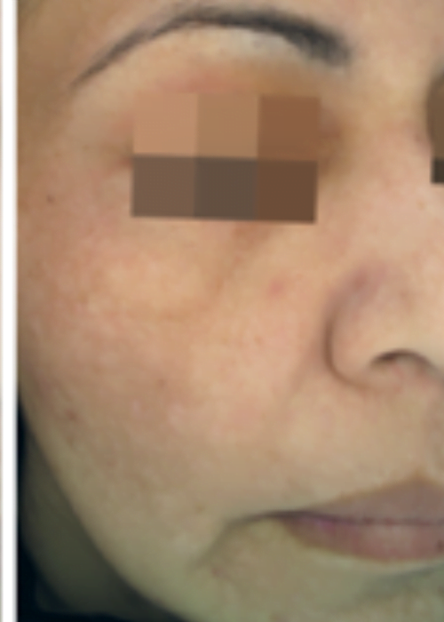 Cosmelan Treatment After