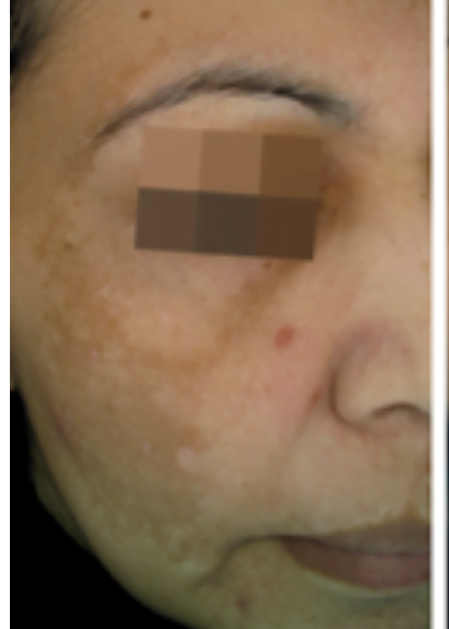 Cosmelan Treatment Before