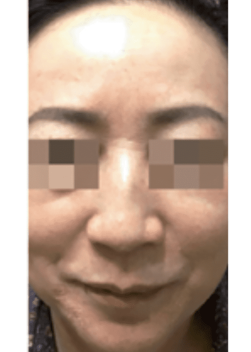 Cosmelan Treatment after london