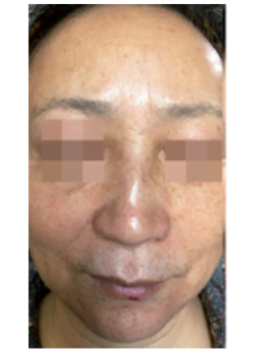 Cosmelan Treatment before london