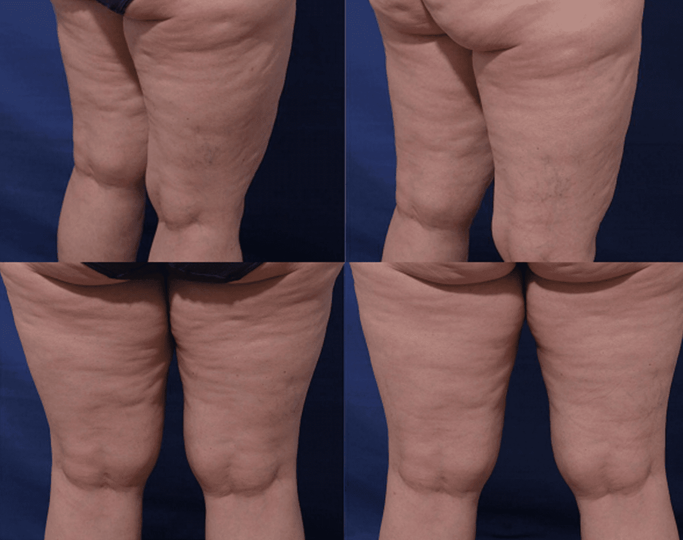 Cellulite Treatment Before