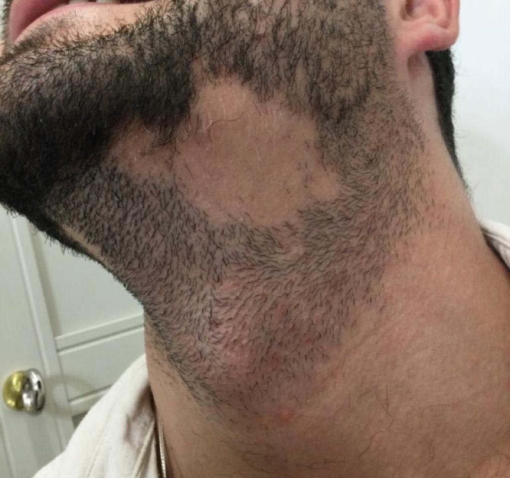 Before doing Alopecia Treatment