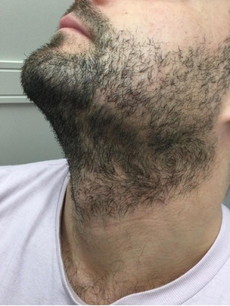 After doing Alopecia Treatment