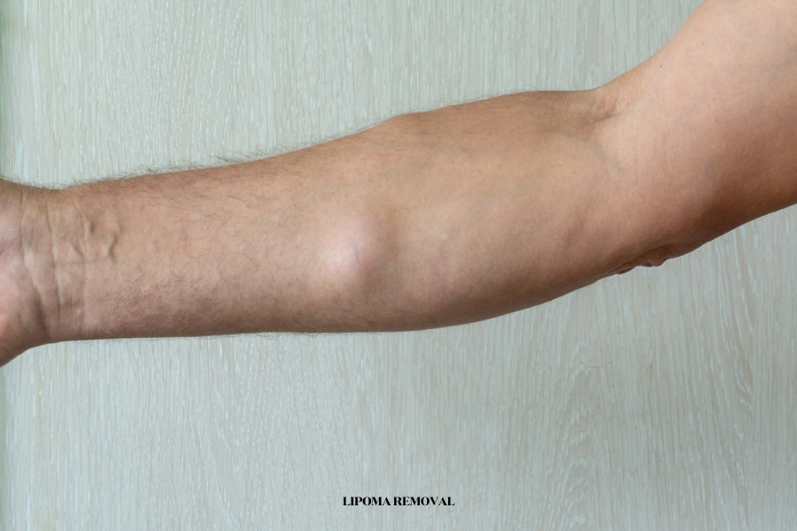 Lipoma removal london