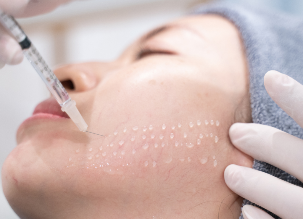 Mesotherapy: Targeted Skin Rejuvenation with Microinjections