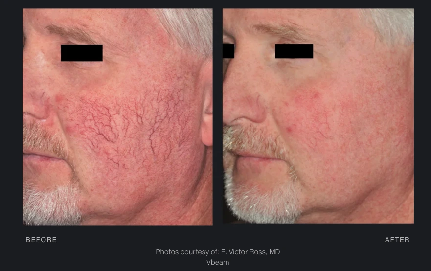 Vbeam Laser Before and After 1